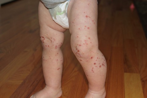 Manchas avermelhadas na pele são os primeiros sintomas da doença, que pode provocar séria infecção  -  Foto:Divulgação/Notisul