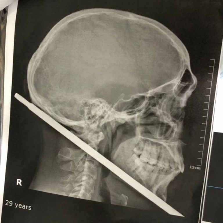 “Eu sou um milagre”, diz paciente após cirurgia para retirada de ferro que atravessou pescoço e crânio